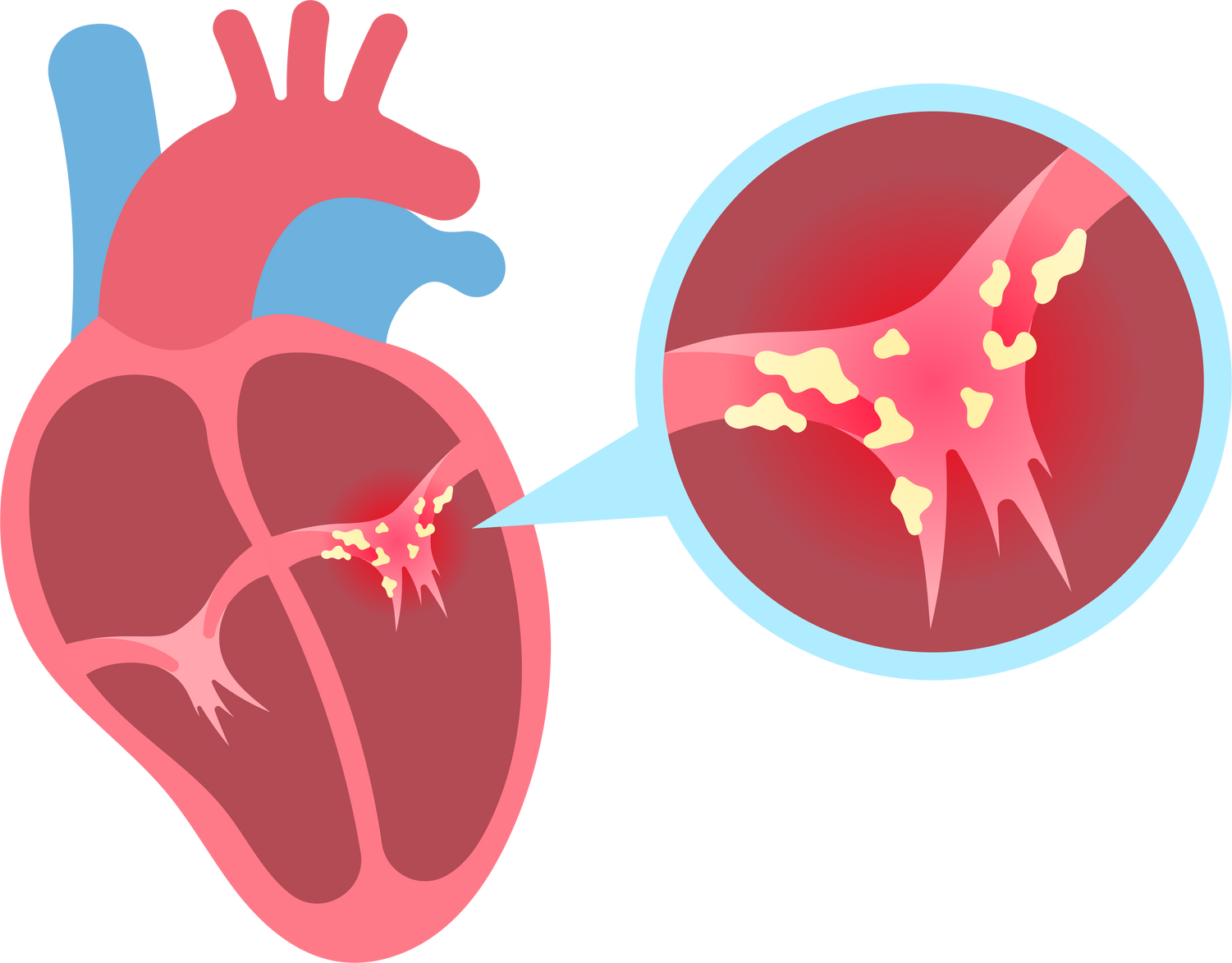 Infective Endocarditis Heart Valve Disease